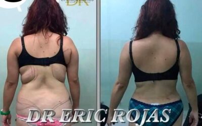 Slim Láser, nuestros increíbles resultados.
