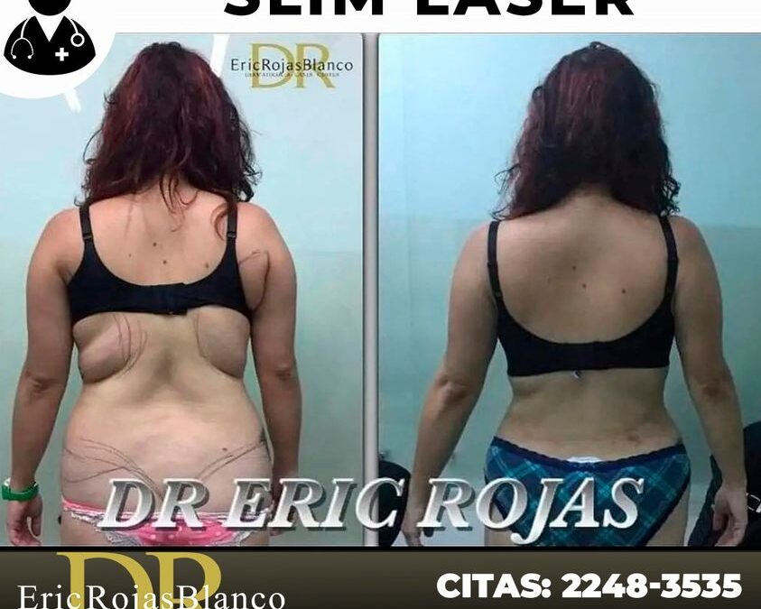 Slim Láser, nuestros increíbles resultados.