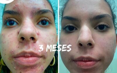 Nosotros eliminamos tu acné, no esperes más.
