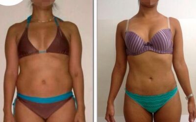 Cambios asombrosos con slim láser, ¿Qué esperas para realizar tu cambio?