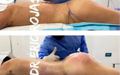 Slim láser trasnferencia en glúteos.