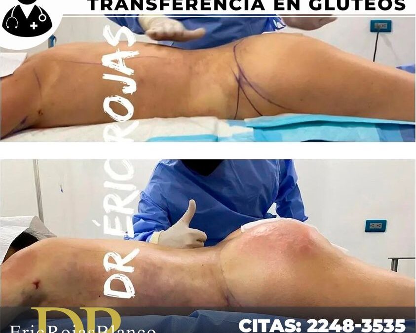 Slim láser trasnferencia en glúteos.