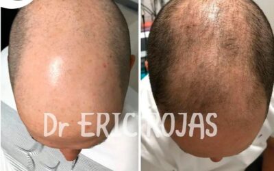 Recupera tu cabello con el Dr. Eric Rojas.