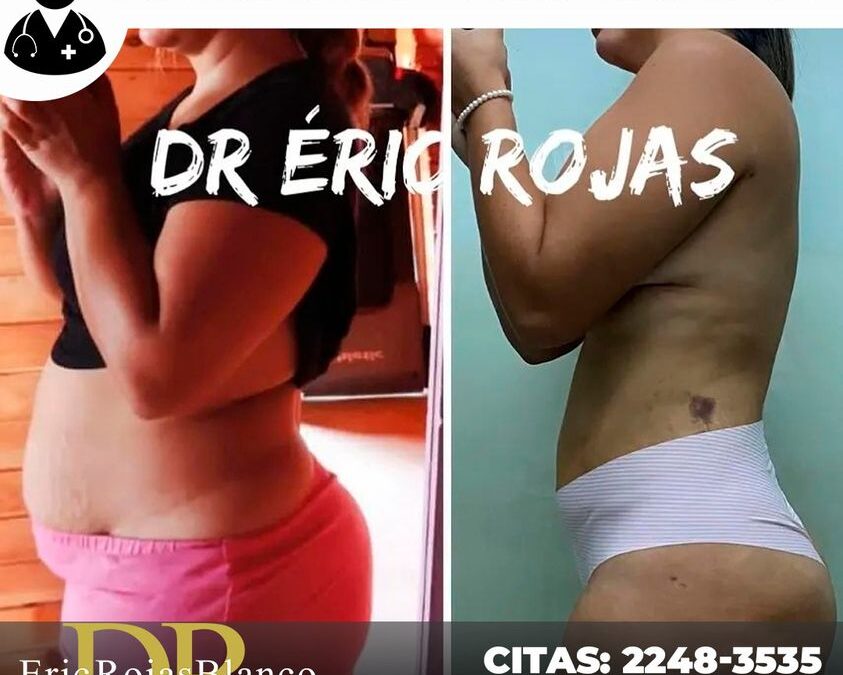 Súper cambio, Slim Láser, ¿Qué esperas para realizar tu cambio?