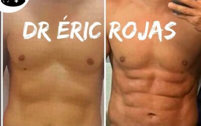 Súper marcaje de abdomen