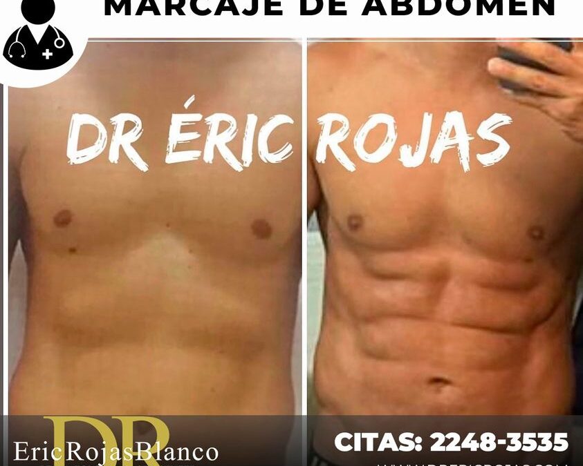 Súper marcaje de abdomen