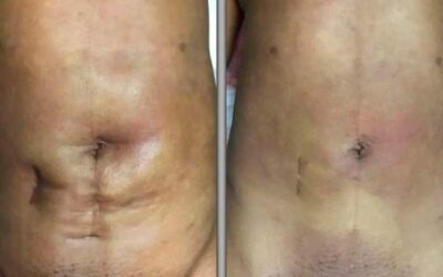 Cesárea, cicatriz de apendicectomía, además de una liposucción anterior.