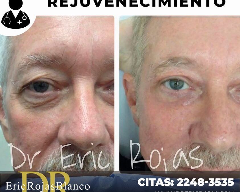 Rejuvenecimiento, ¿Increíble el resultado, no?