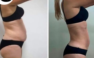 Slim láser en abdomen, ¿Por qué no tener ese resultado en ti?