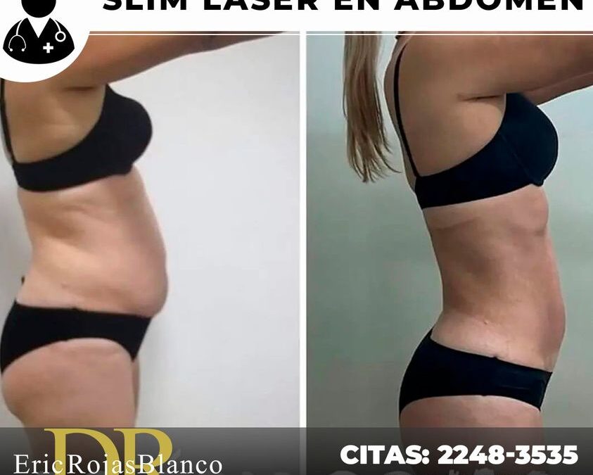 Slim láser en abdomen, ¿Por qué no tener ese resultado en ti?
