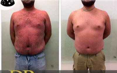 Solución a la Psoriasis