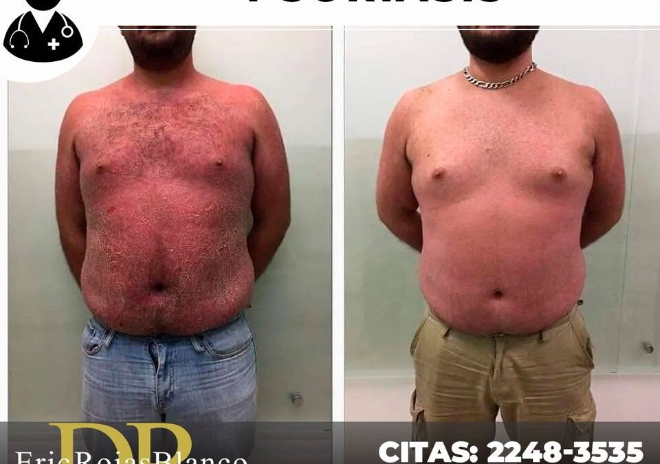 Solución a la Psoriasis