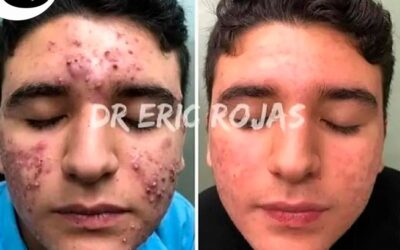 Cambios impresionantes en acné.