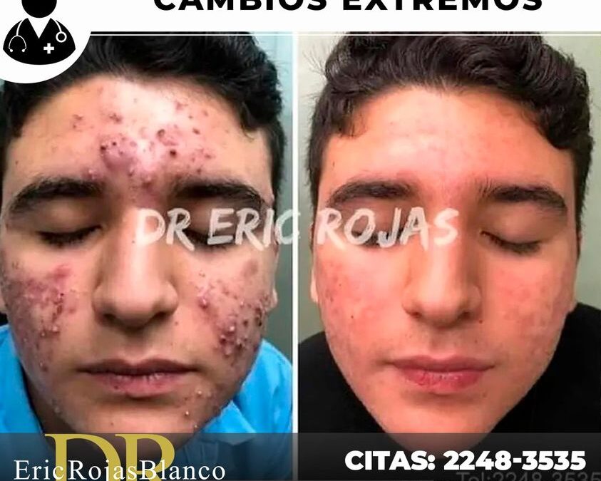 Cambios impresionantes en acné.