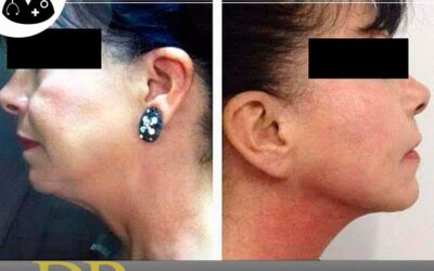 Elimina tu papada con Slim Láser, no espere más.