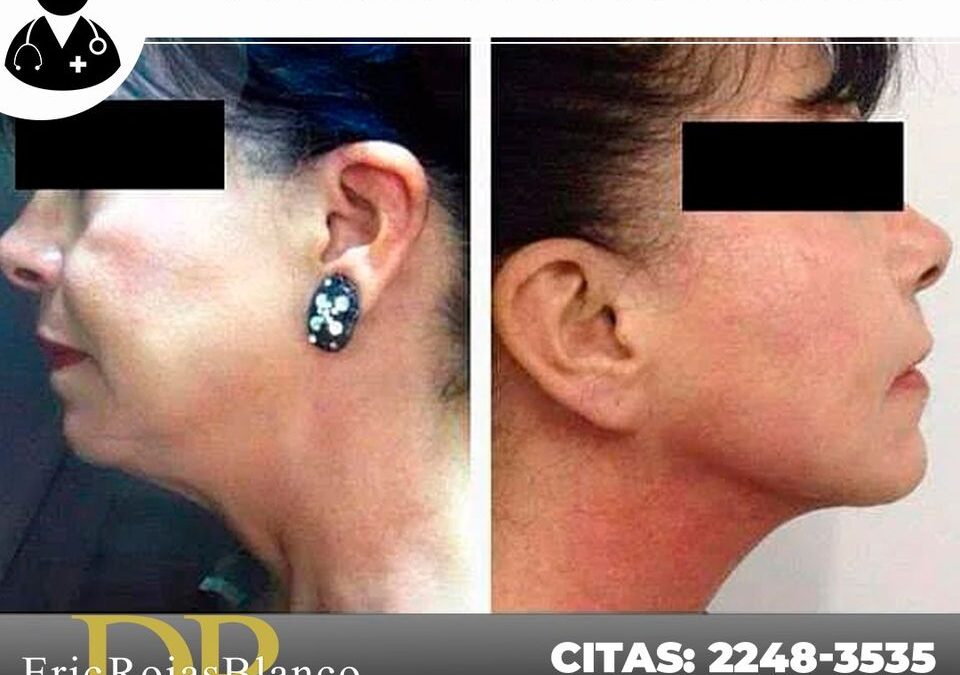 Elimina tu papada con Slim Láser, no espere más.