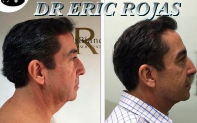 Eliminación de papada Dr Eric Rojas