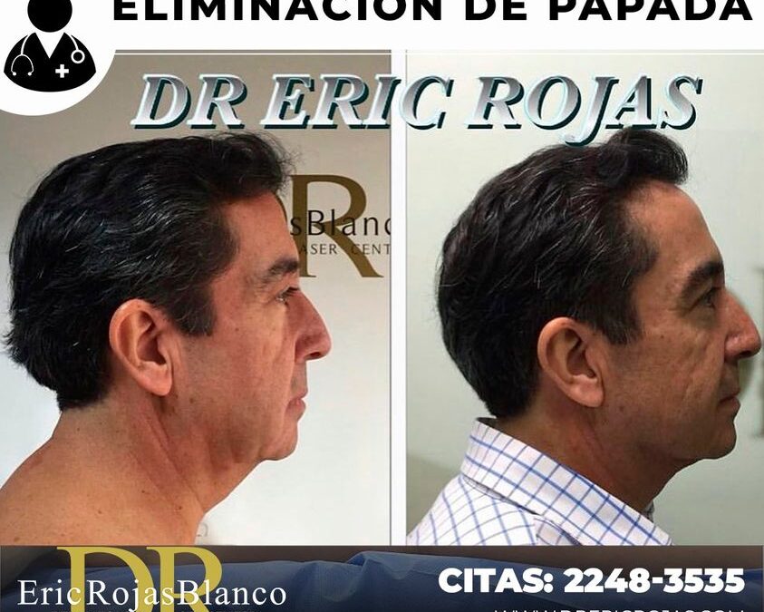 Eliminación de papada Dr Eric Rojas