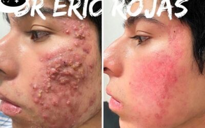 Te brindamos un rostro perfecto libre de acné.