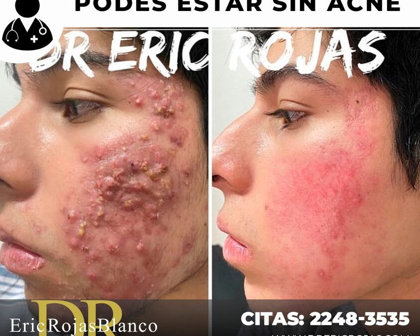 Te brindamos un rostro perfecto libre de acné.