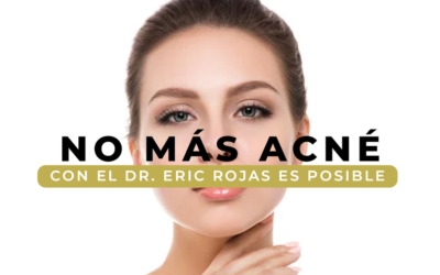 Todo es mejor sin acné.