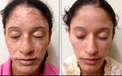 Solucionamos Dermatitis Seborreica