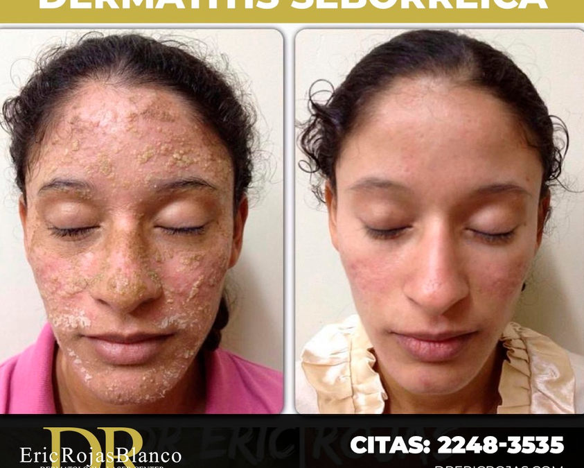 Solucionamos Dermatitis Seborreica