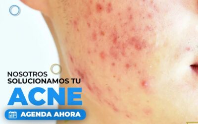 Tenemos la solución para el acné.