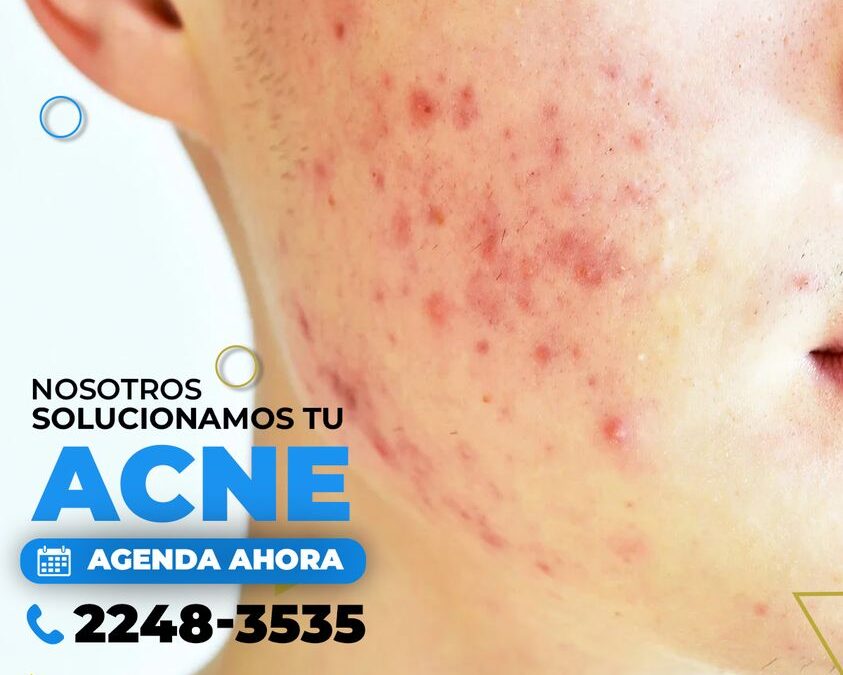 Tenemos la solución para el acné.