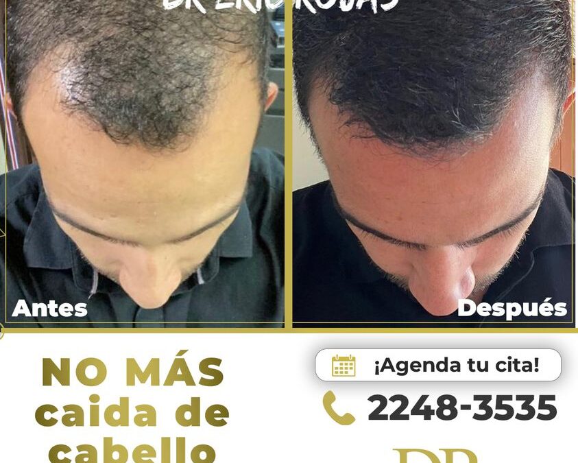 No perdás más cabello