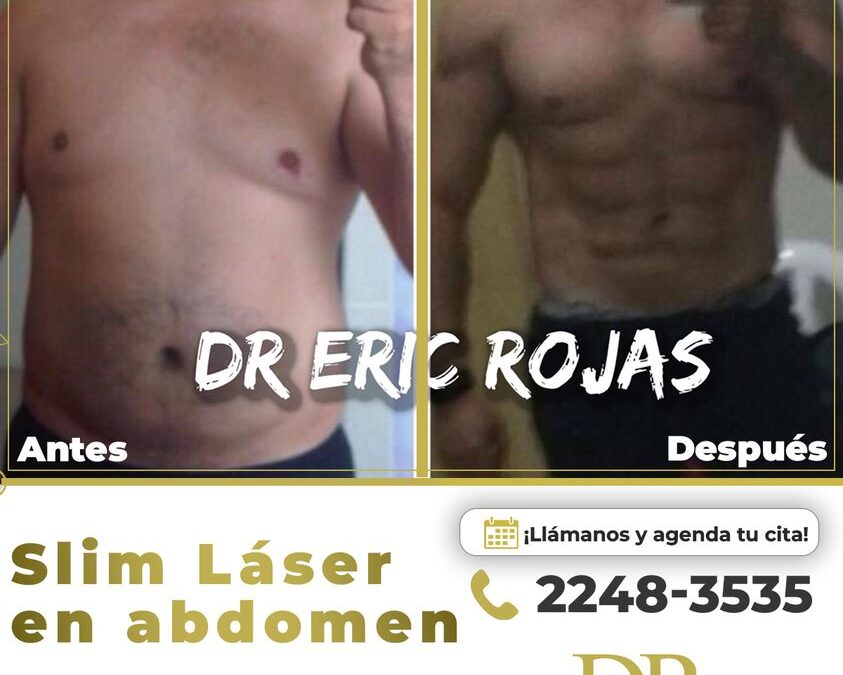 ¿Sabías que el slim láser puede mejorar totalmente tu apariencia?