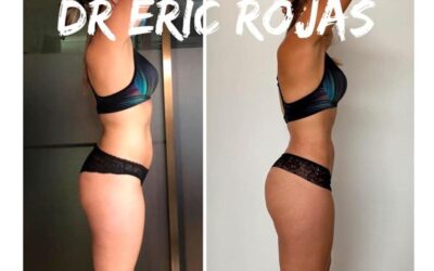 Moldea tu figura con Slim Láser, procedimiento exclusivo del Dr. Eric Rojas Blanco
