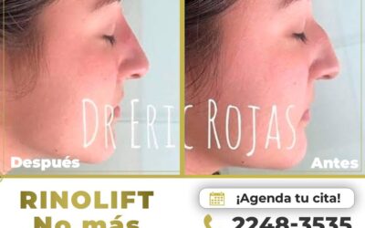 ¡Rinolift es la solución a tus complejos! En una sola sesión tendrás cambios increíbles.