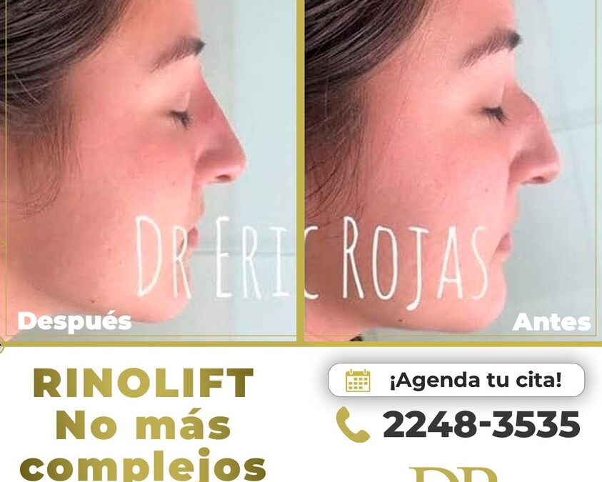 ¡Rinolift es la solución a tus complejos! En una sola sesión tendrás cambios increíbles.
