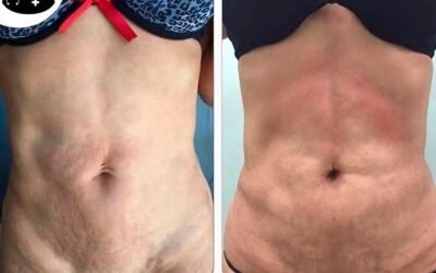 Mejoría de un ombligo caído mediante Slim Láser.