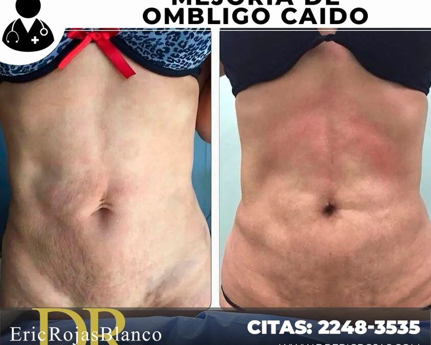 Mejoría de un ombligo caído mediante Slim Láser.