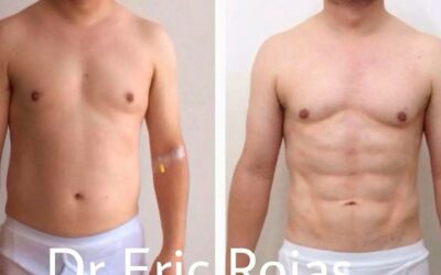 Marcaje de abdomen mediante Slim Láser, puedes ver el increíble resultado de nuestro paciente.