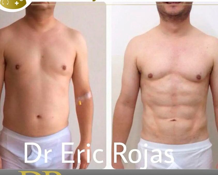 Marcaje de abdomen mediante Slim Láser, puedes ver el increíble resultado de nuestro paciente.