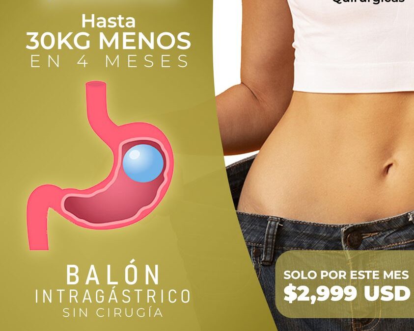 Balón intragástrico sin cirugía.