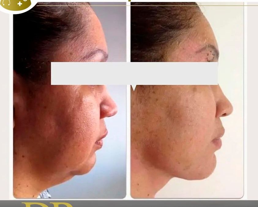 Slim Láser en papada, dale una nueva imagen a tu rostro.