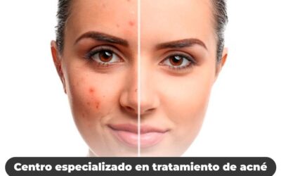 Dile adiós al acné con nuestro tratamiento 100% efectivo.