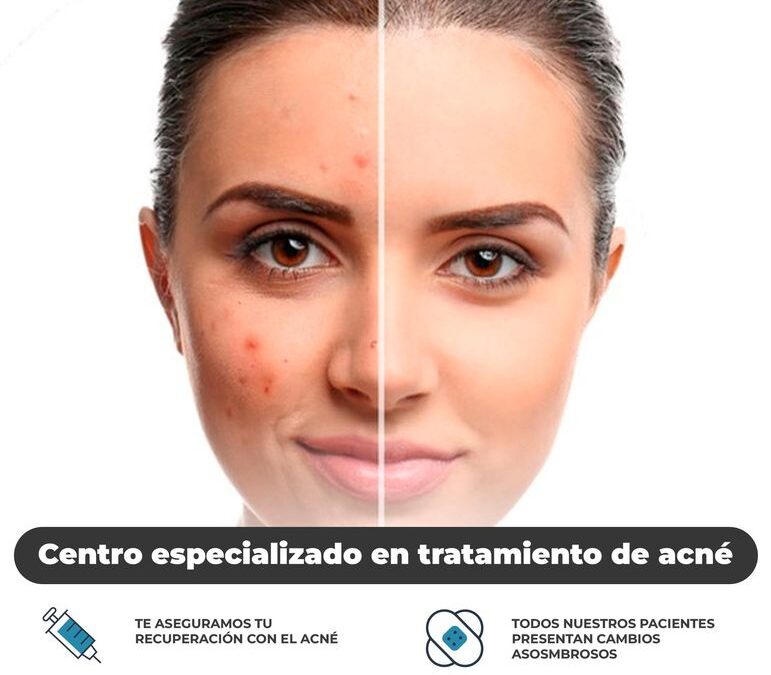 Dile adiós al acné con nuestro tratamiento 100% efectivo.