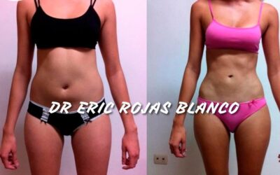 Slim Láser, increíbles resultados en nuestros pacientes, ¿Qué esperas para obtener tu cambio?