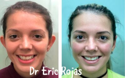 Corrección de orejas con dermo otoplastía, una gran opción para ti.