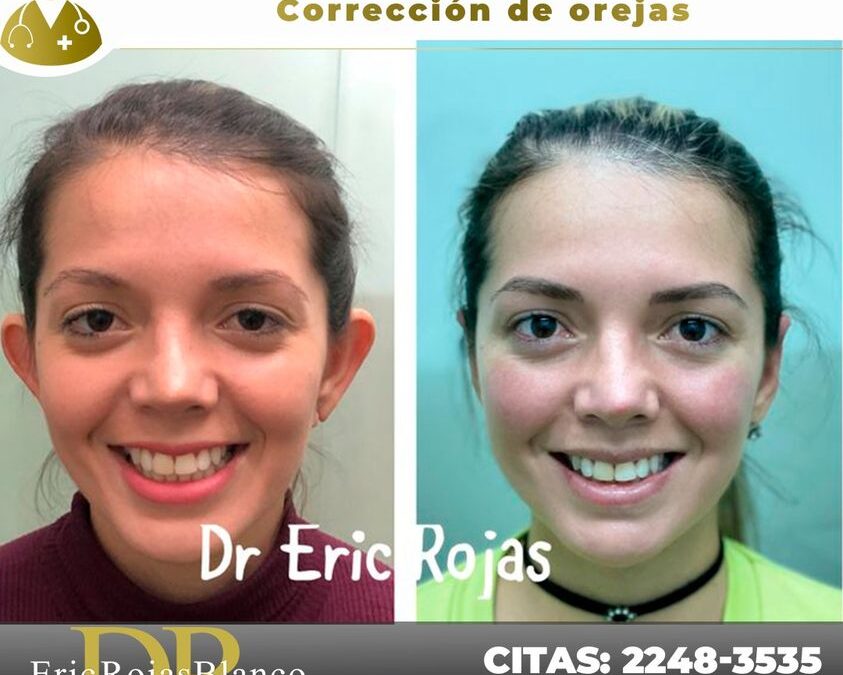 Corrección de orejas con dermo otoplastía, una gran opción para ti.