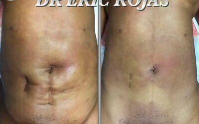 Cesárea, cicatriz de apendicectomía, además de una liposucción anterior.