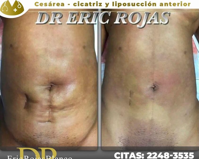Cesárea, cicatriz de apendicectomía, además de una liposucción anterior.