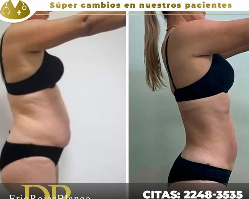 Estos son los súper resultados que puedes obtener con el Slim Láser