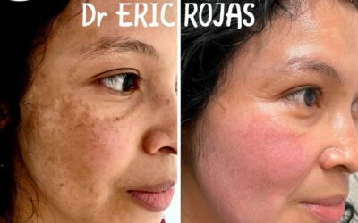 Elimina las manchas de tu rostro de manera exitosa con nuestro tratamiento.