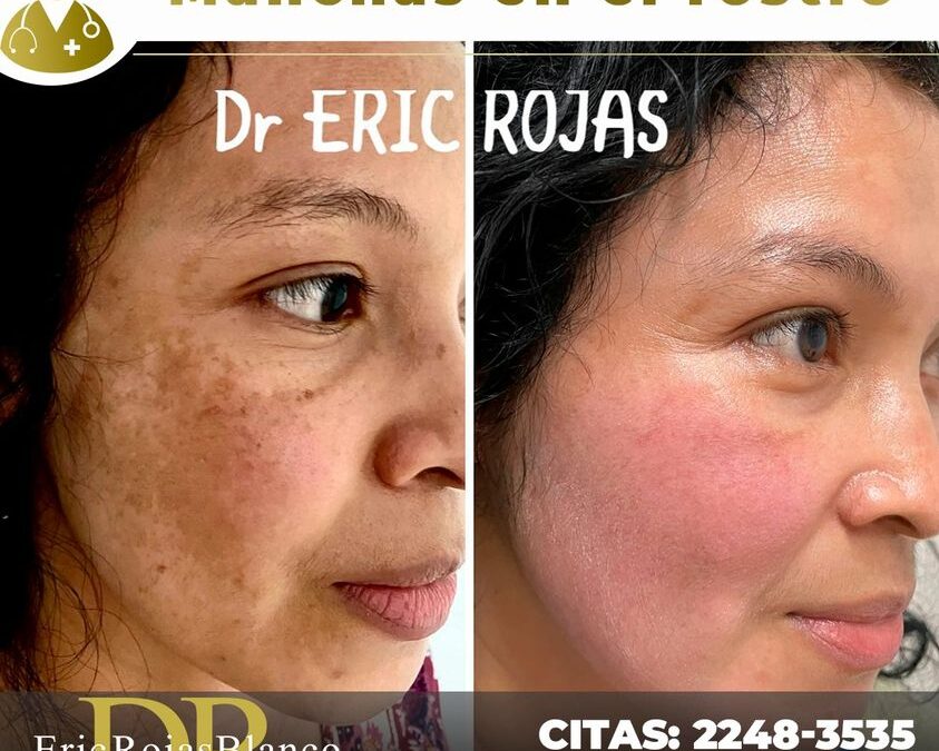 Elimina las manchas de tu rostro de manera exitosa con nuestro tratamiento.